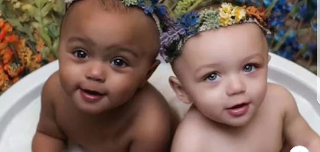 Confira as fotos das gêmeas de cores diferentes depois de adultas