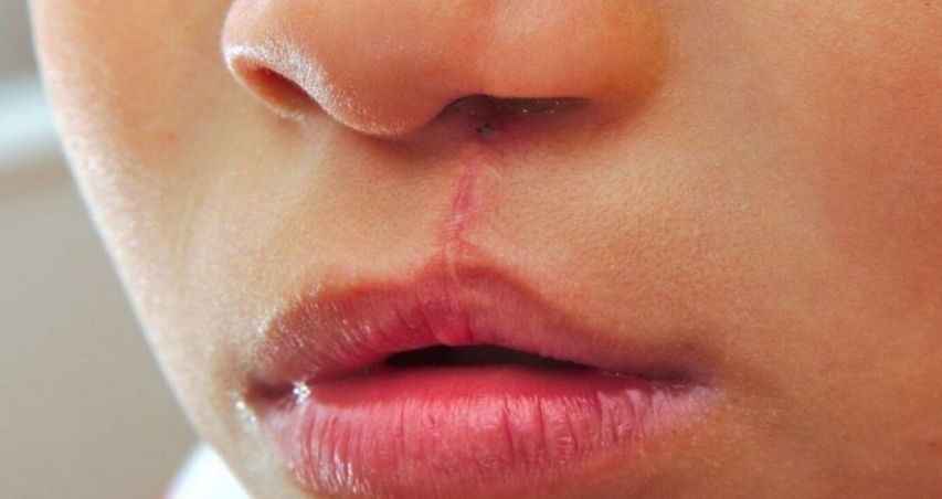 Sobe número de bebês abortados após diagnóstico de lábio leporino