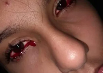 Conheça Fernanda melim, a menina brasileira que chora sangue