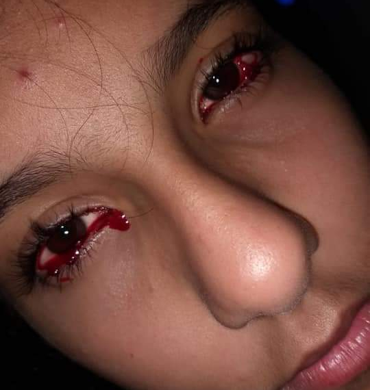 Conheça Fernanda melim, a menina brasileira que chora sangue