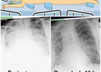 URGENTE:  Manter o paciente de cabeça para baixo pode prevenir até 50 % das mortes por Covid-19