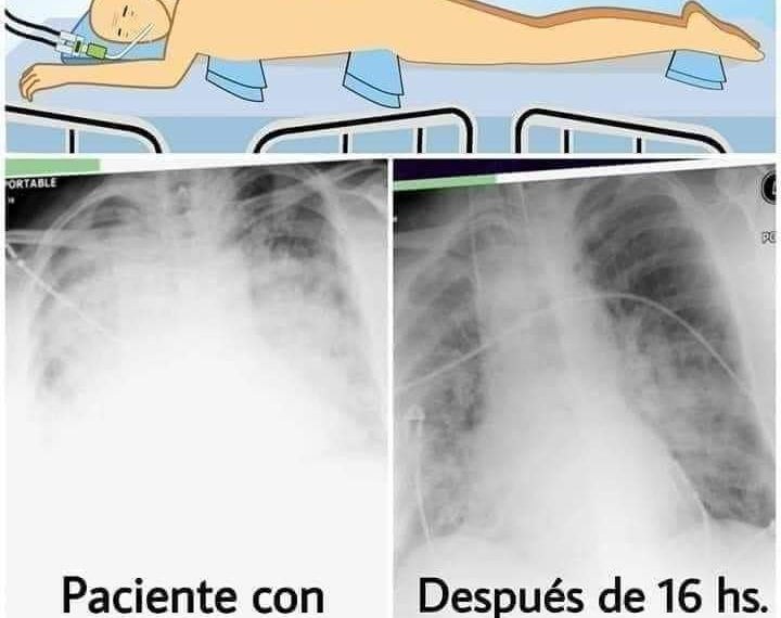 URGENTE:  Manter o paciente de cabeça para baixo pode prevenir até 50 % das mortes por Covid-19