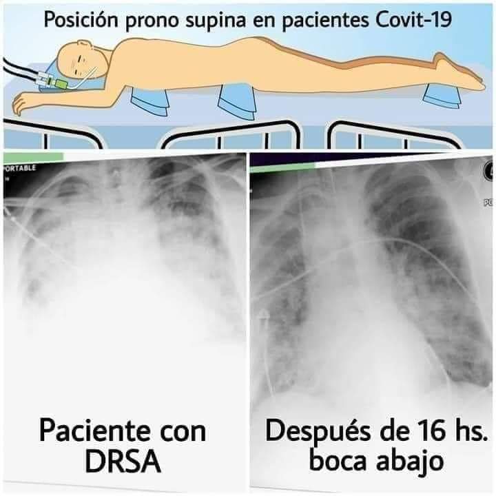 URGENTE:  Manter o paciente de cabeça para baixo pode prevenir até 50 % das mortes por Covid-19