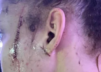 Sobrinha de Michael Jackson sofre ataque racista e é esfaqueada