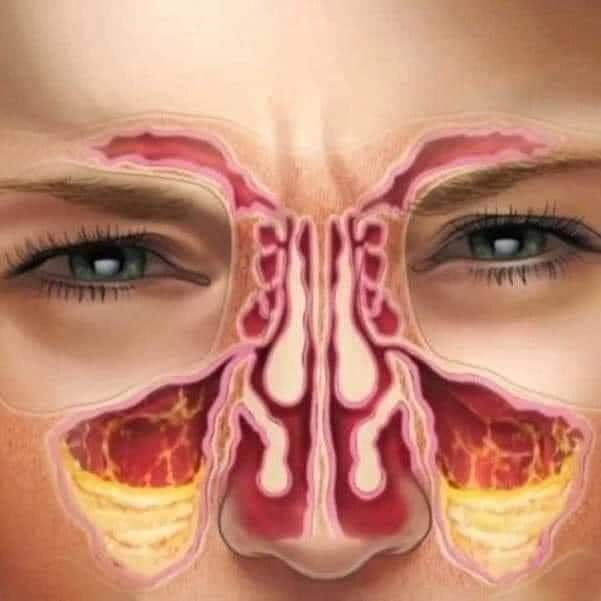 Atenção!! Pra você que tem Rinite ,Sinusite e bronquite!!