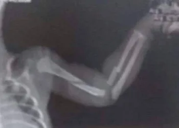 BEBÊ DE UM MÊS CHEGA A HOSPITAL COM FRATURAS E MAE É PRESA NO RIO