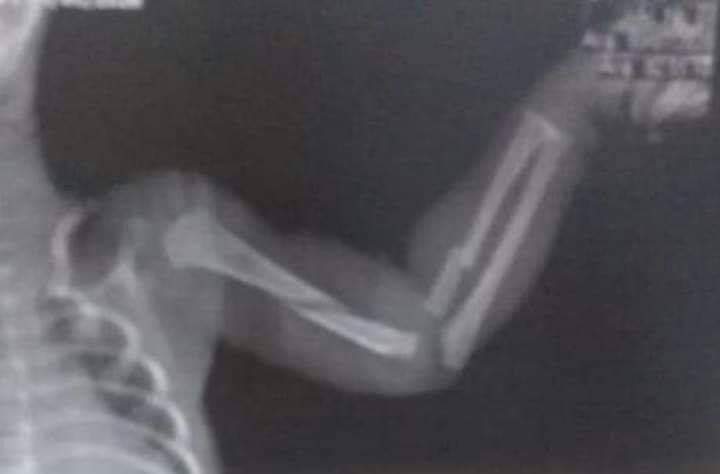 BEBÊ DE UM MÊS CHEGA A HOSPITAL COM FRATURAS E MAE É PRESA NO RIO