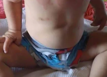 BEBÊ DE 10 MESES SE INFECTOU DE COVID!! VEJA OS SINTOMAS