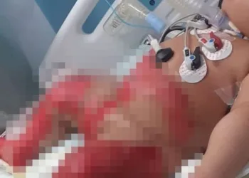 Morre bebê queimada em hospital no RJ