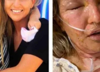 Mulher tem corpo queimado após usar álcool gel para acender vela