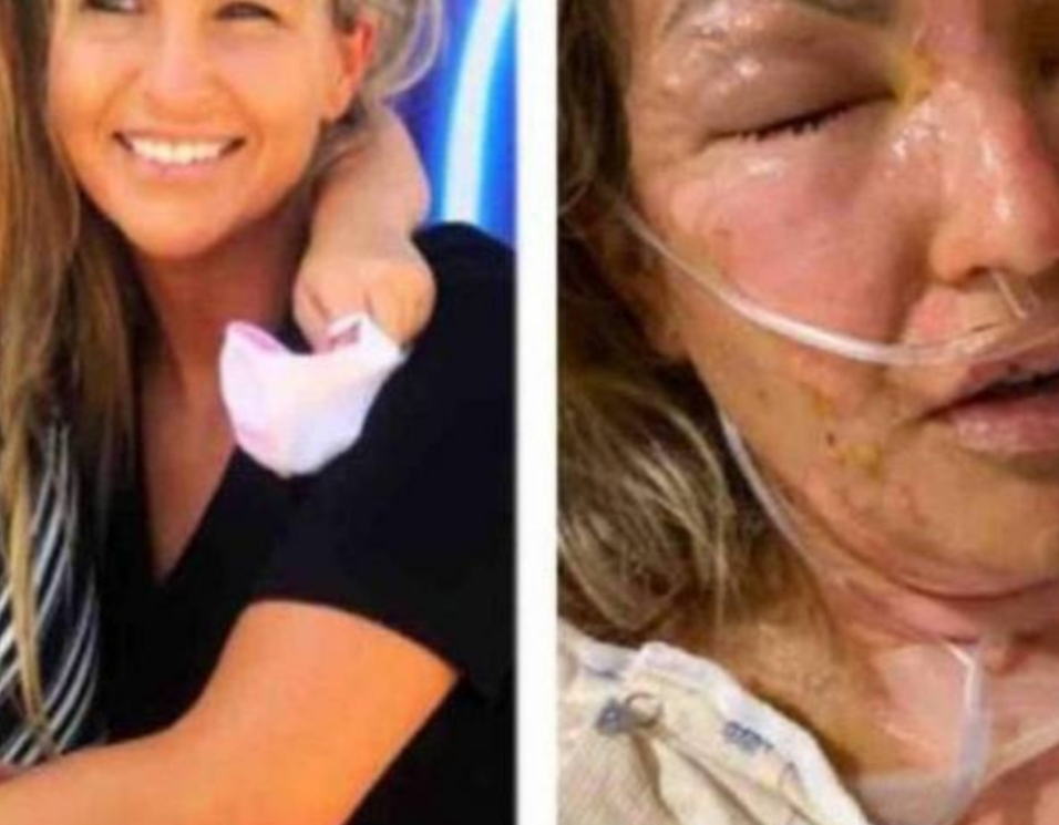 Mulher tem corpo queimado após usar álcool gel para acender vela