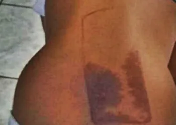 Menina sofre queimaduras nas costas ao dormir em cima do celular no RJ