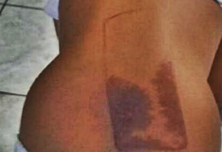 Menina sofre queimaduras nas costas ao dormir em cima do celular no RJ