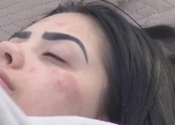 MC Mirella tem reação alérgica e peões ficam preocupados