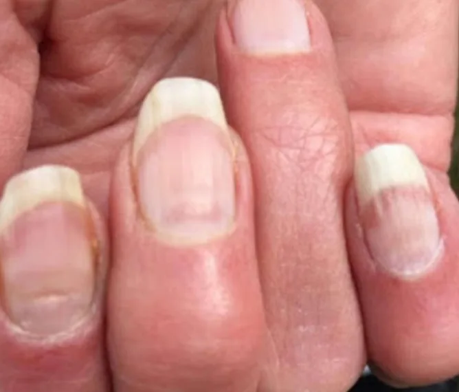 Marca na unha pode indicar quem já teve covid-19, diz cientista