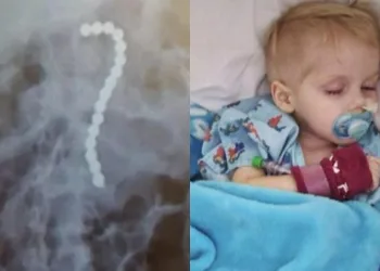 Criança de 2 anos fica em estado grave após ingerir vários ímãs; mãe faz apelo