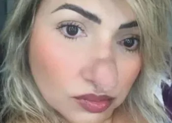 Mulher faz cirurgia para corrigir desvio de septo e nariz dobra de tamanho, sofre preconceito