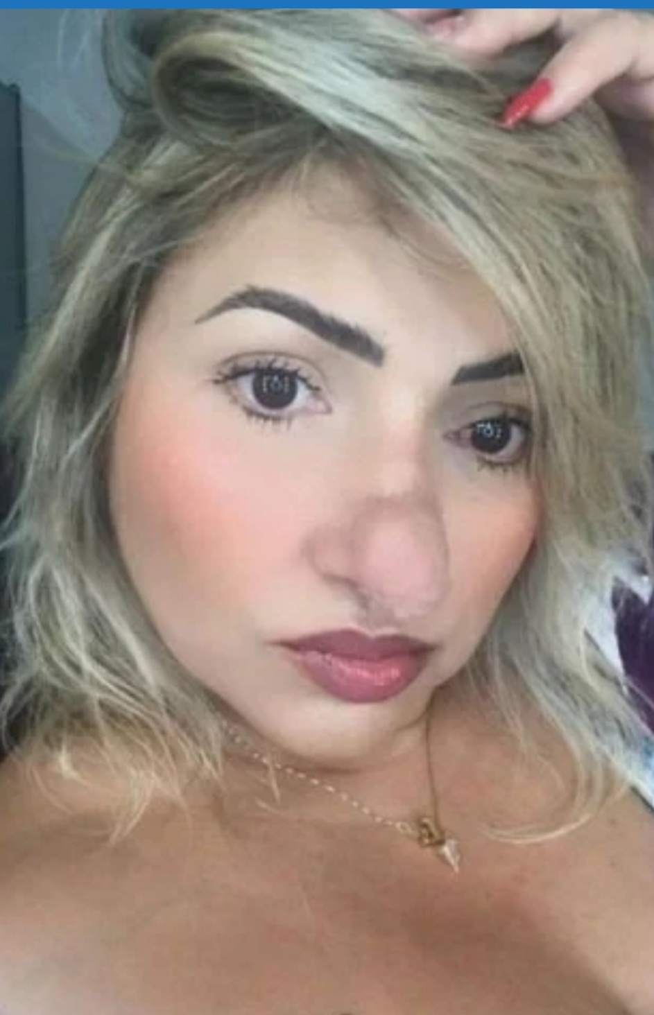 Mulher faz cirurgia para corrigir desvio de septo e nariz dobra de tamanho, sofre preconceito