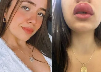 JOVEM LEVA PICADA DE LACRAIA E FICA COM BOCA DE “ANGELINA JOLIE”