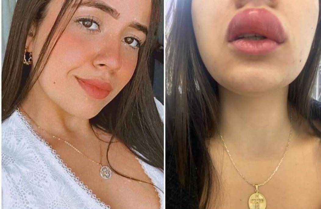 JOVEM LEVA PICADA DE LACRAIA E FICA COM BOCA DE “ANGELINA JOLIE”