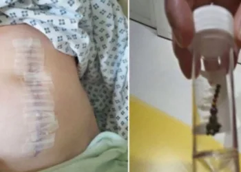 Adolescente perde parte do intestino após ‘desafio’ no TikTok