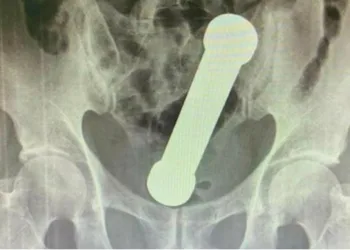 Homem faz cirurgia para remover haltere do ânus
