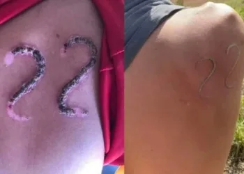 Jovem usa ferro em brasa para marcar 22 de Bolsonaro na pele