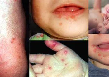 DOENÇA MÃO-PÉ-BOCA: CONHEÇA CAUSAS, SINTOMAS, CUIDADOS E TRATAMENTOS DESSA DOENÇA