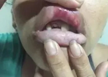 Garota de programa tem dois dentes quebrados por namorado ciumento ao sair para trabalhar