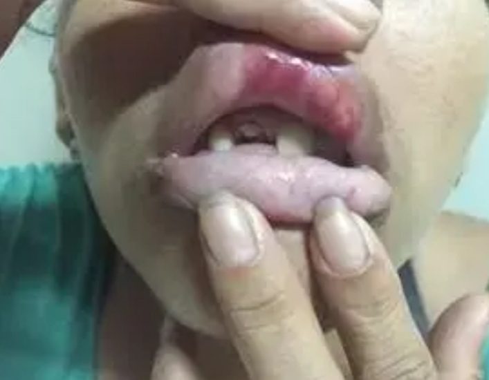 Garota de programa tem dois dentes quebrados por namorado ciumento ao sair para trabalhar