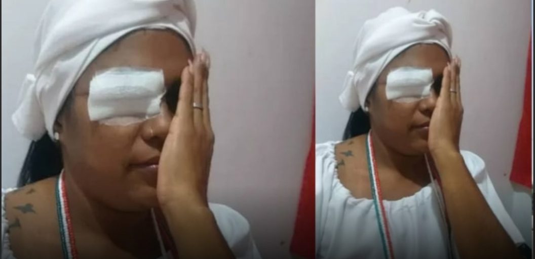 Manicure diz que perdeu um olho ao ser atacada por vizinho por ouvir ‘música de macumba’, no RJ