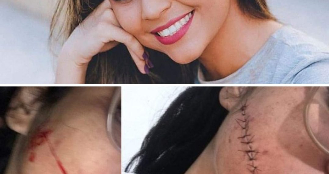 Jovem tem o rosto cortado enquanto dormia em viagem de ônibus