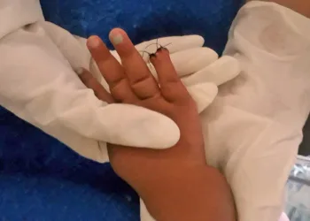 Bebê internada por picada na testa tem parte do dedo amputada após corte na hora de tirar atadura