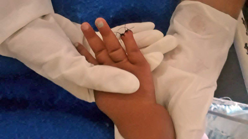 Bebê internada por picada na testa tem parte do dedo amputada após corte na hora de tirar atadura
