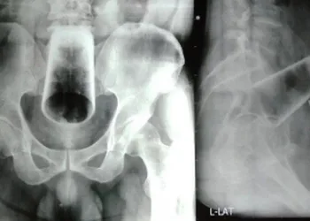 MÉDICOS REMOVEM COPO DE 12 CM DO ÂNUS DE UM HOMEM APÓS MOMENTO ‘RECREATIVO