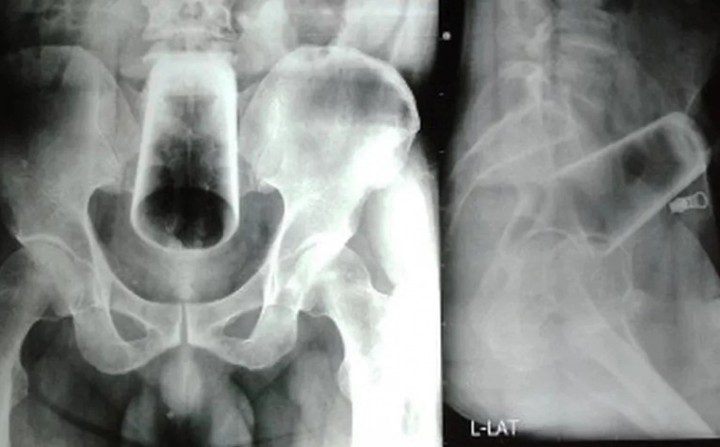MÉDICOS REMOVEM COPO DE 12 CM DO ÂNUS DE UM HOMEM APÓS MOMENTO ‘RECREATIVO