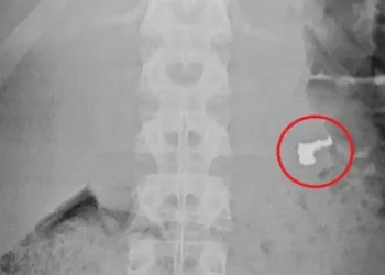 Adolescente engole corrente de ouro roubada para não ser apreendido, mas joia é identificada na radiografia