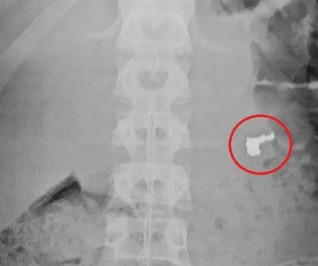 Adolescente engole corrente de ouro roubada para não ser apreendido, mas joia é identificada na radiografia