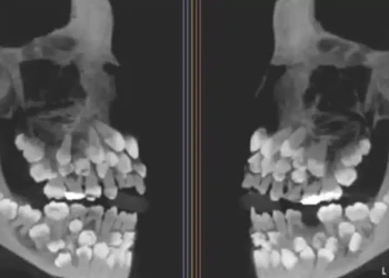 Menina de 11 anos surpreende ao ter 81 dentes: “É um quebra-cabeça para os médicos”