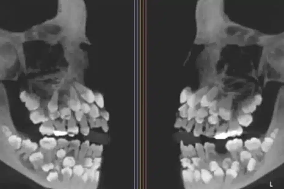 Menina de 11 anos surpreende ao ter 81 dentes: “É um quebra-cabeça para os médicos”