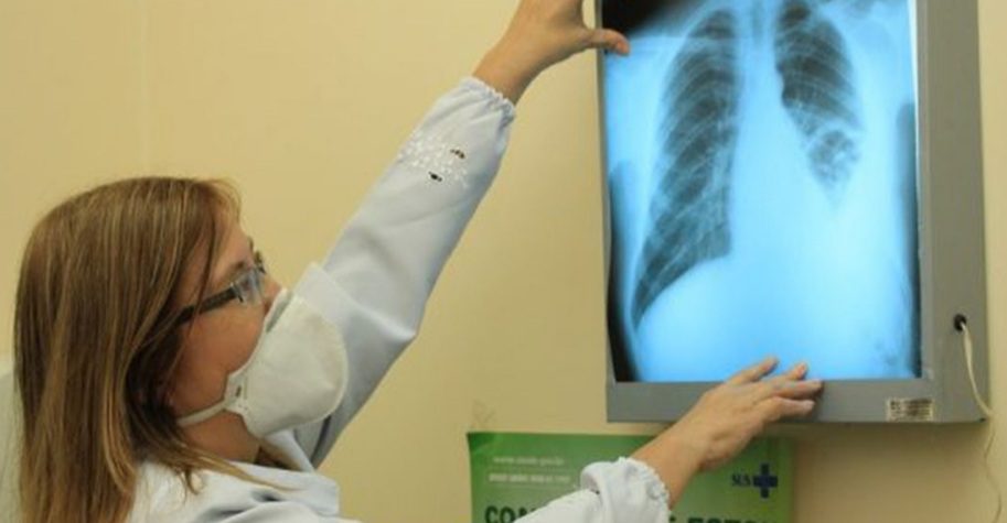 Conselho aprova novas diretrizes para tratamento da tuberculose no SUS