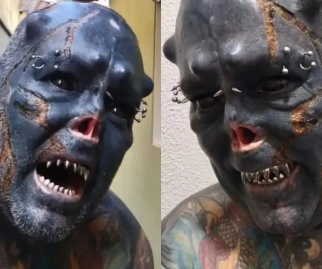 A “Caveira” do interior de São Paulo queimou a pele do rosto em um novo procedimento, após mutilar o nariz, as orelhas e os dentes. De acordo com relatos, a dor experimentada foi extrema.