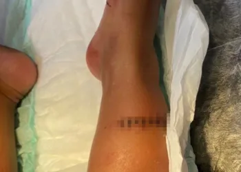 Menina de 2 anos sofre corte com linha chilena nas duas pernas em Santa Cruz