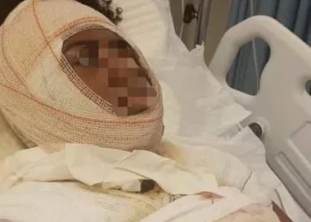 Homem é acusado de jogar água fervendo na ex-companheira em Campo Grande