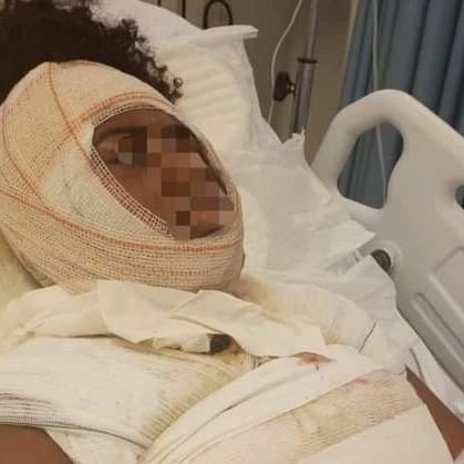Homem é acusado de jogar água fervendo na ex-companheira em Campo Grande