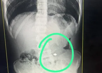Jovem Preso na Barra da Tijuca por Furtar e Engolir Cordão de Ouro