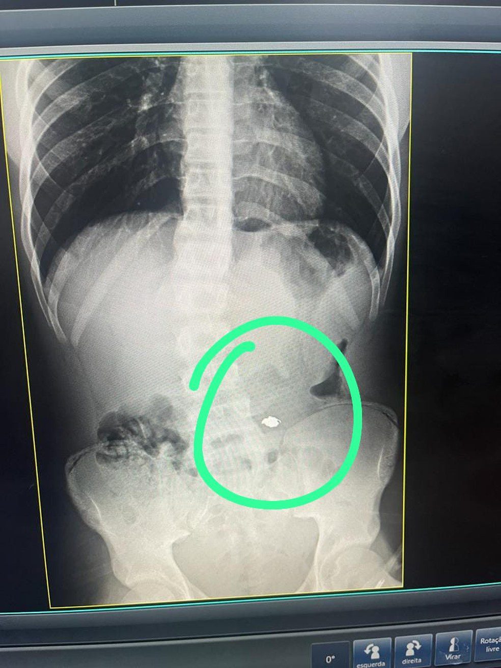 Jovem Preso na Barra da Tijuca por Furtar e Engolir Cordão de Ouro