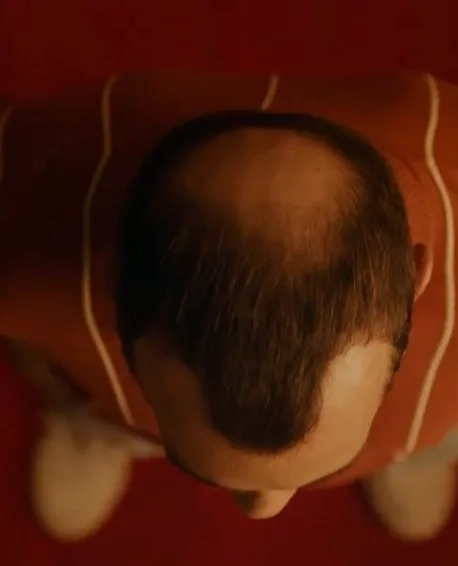 Burger King Oferece Lanches Grátis para Calvos em Promoção Inusitada