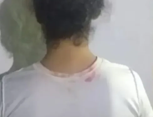 ( fotos) Identificada e presa a invejosa que jogou ácido em jovem