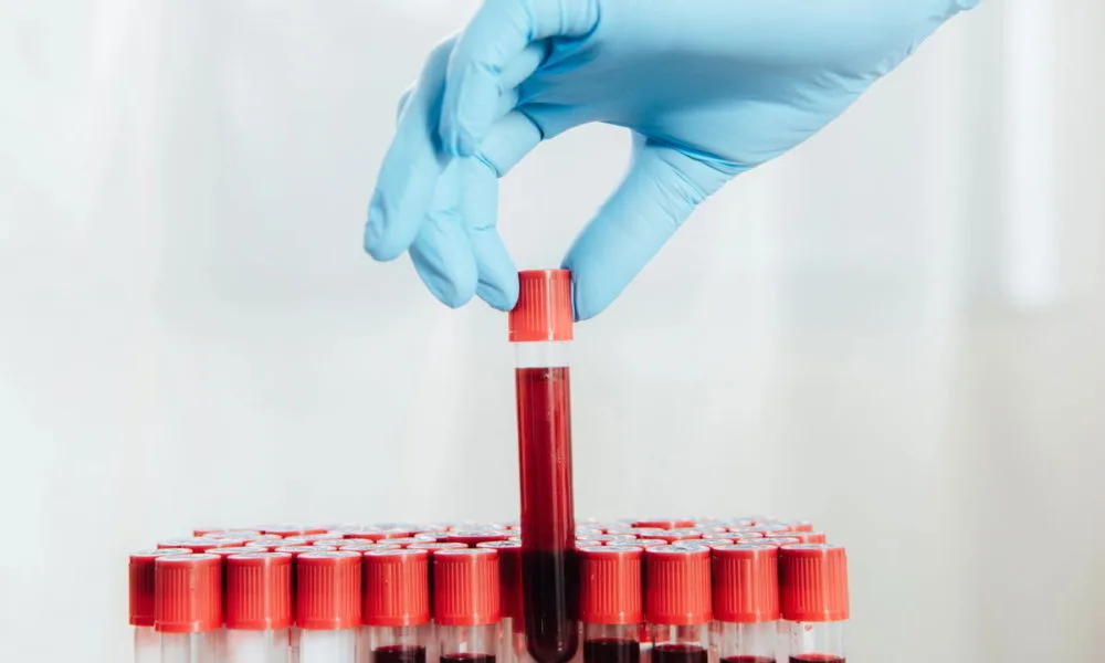 Novo exame de sangue inovador possibilita detecção precoce da diabetes.